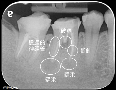 複合難症 術前