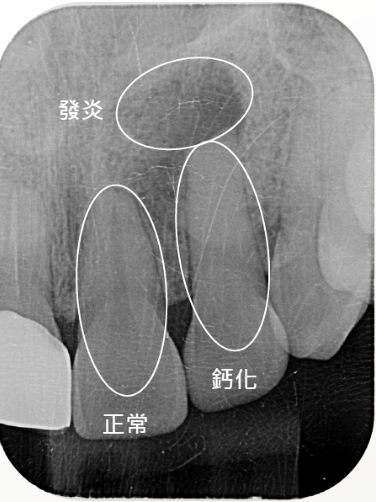 門牙根尖發炎 術前