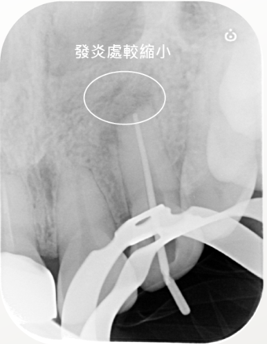 門牙根尖發炎 治療中