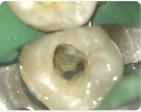 顯微鏡下找到根管孔