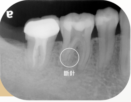 器械斷針術前 X 光
