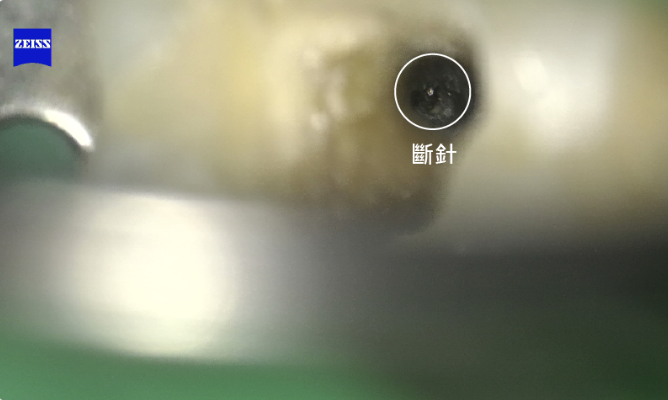 取出的斷針對照