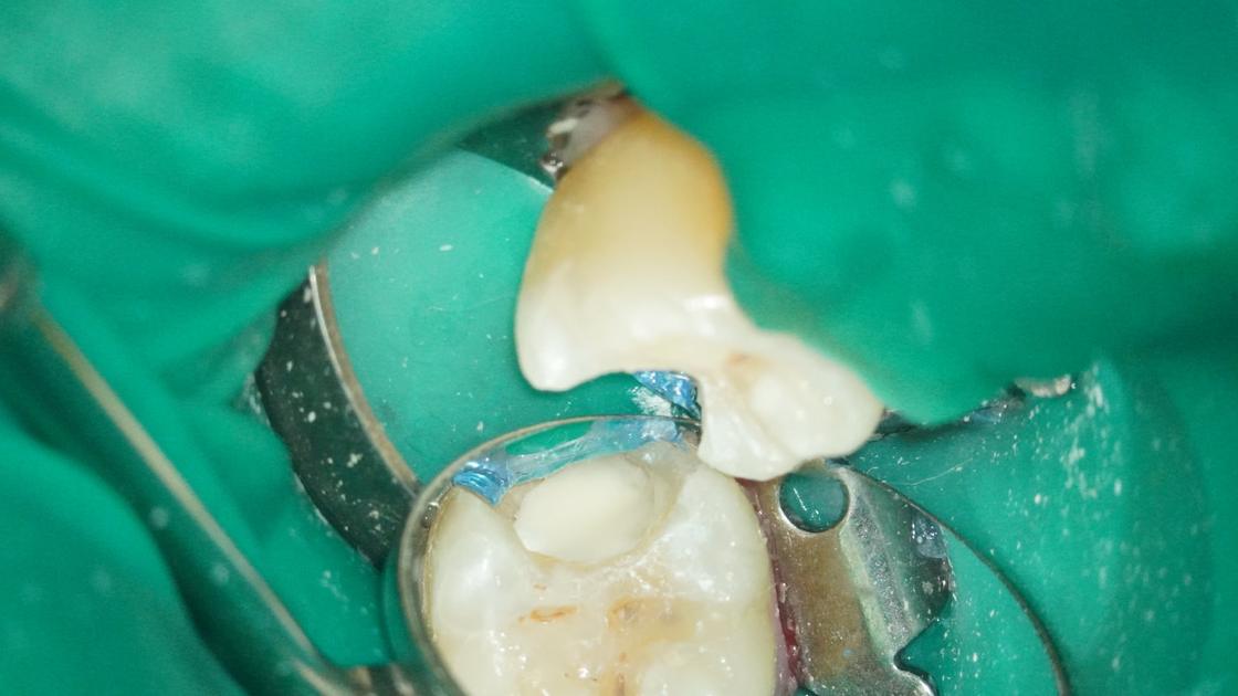 於神經上覆蓋生物陶瓷