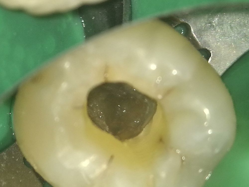 顯微鏡下,牙齒打開後只看到一片平坦的鈣化齒質
