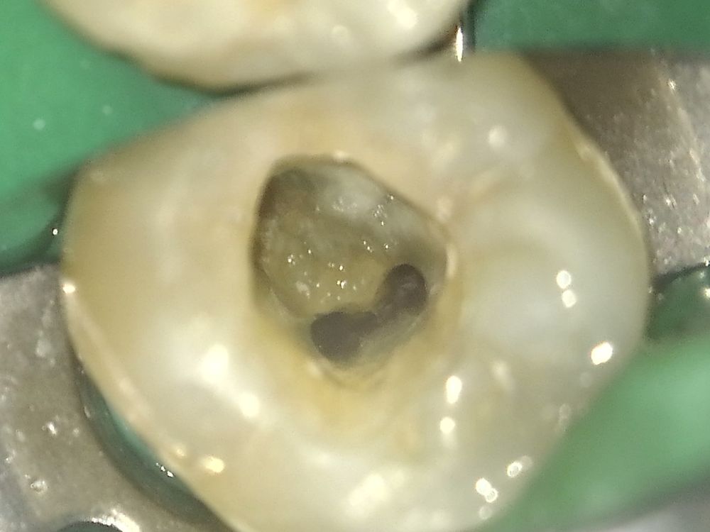 顯微鏡下,找到並擴大的根管入口