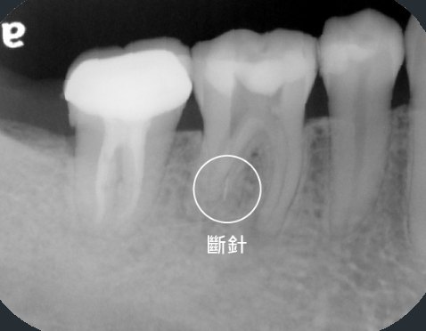 右下第一大臼齒的 X 光,圈起處為根管內的分離器械