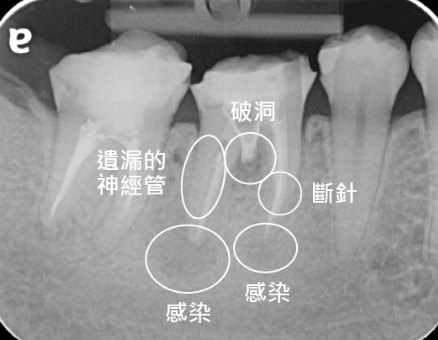 右下第一大臼齒的 X 光,標示遺漏的神經管、破洞、斷針與感染位置